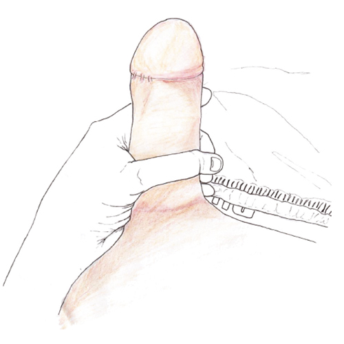 illustration by Chris: 'my first dick pic' post-operatieve depressie‘My first dickpic’ door Chris